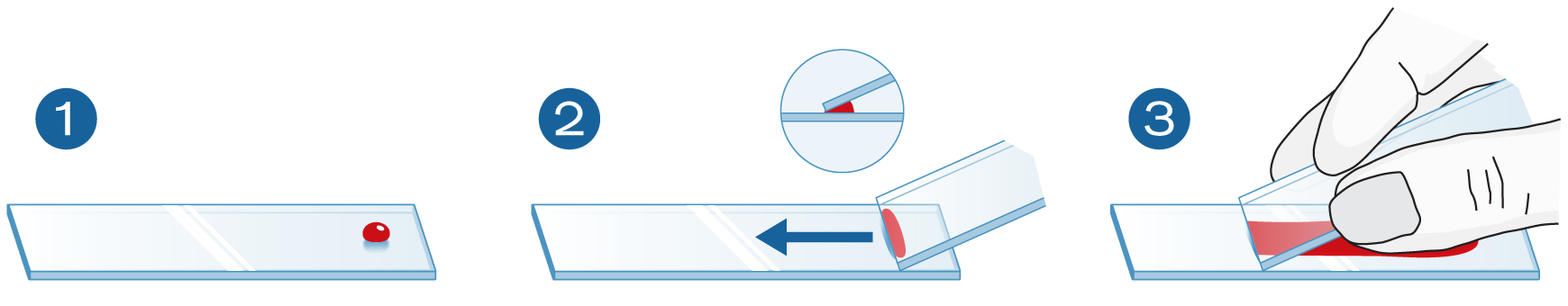 Illustration Methode zur Probenentnahme mittels Blutstrich
